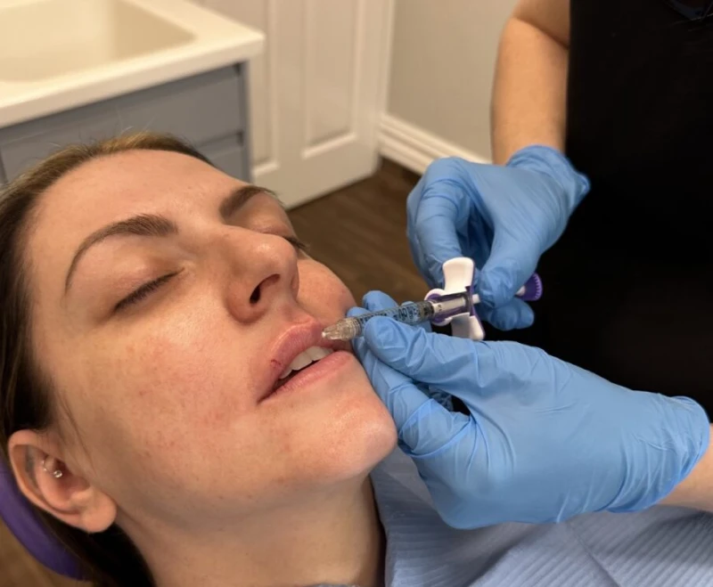 Dermal Fillers section 3